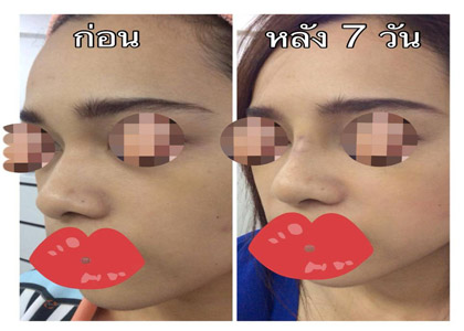 คลินิกนริทร์-พิลัมภา ความงามเหนือระดับที่ใครก็สั่งได้ บริการ เสริมจมูก